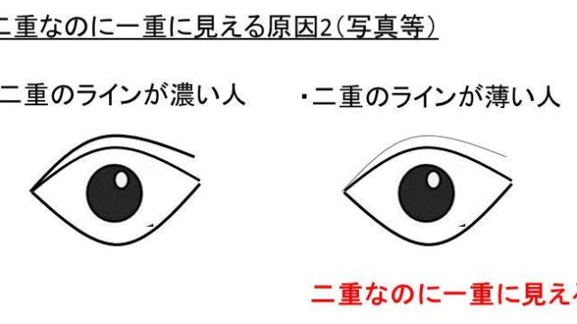 片目だけ二重になる原因は 直す方法 治す方法 は アイプチや整形もあり 白丸くん